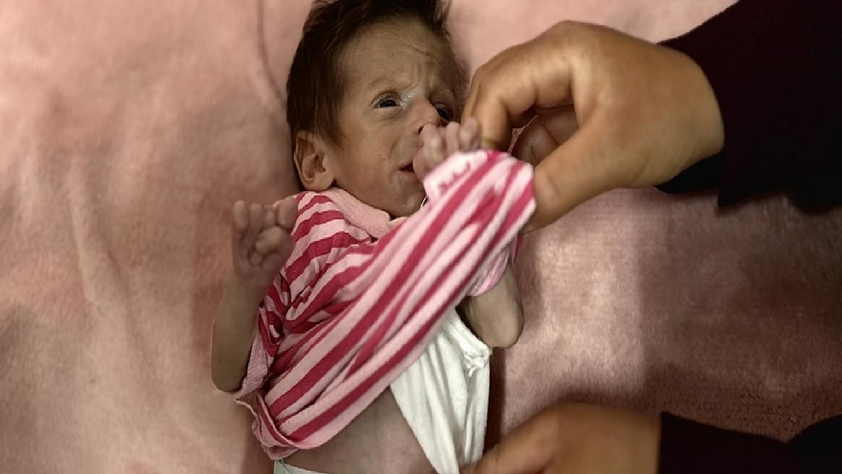 Gazze’de bir bebek daha açlık yüzünden can vermek üzere