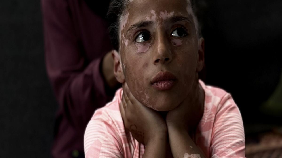 Gazzeli Lana, İsrail korkusu yüzünden vitiligo hastalığına yakalandı